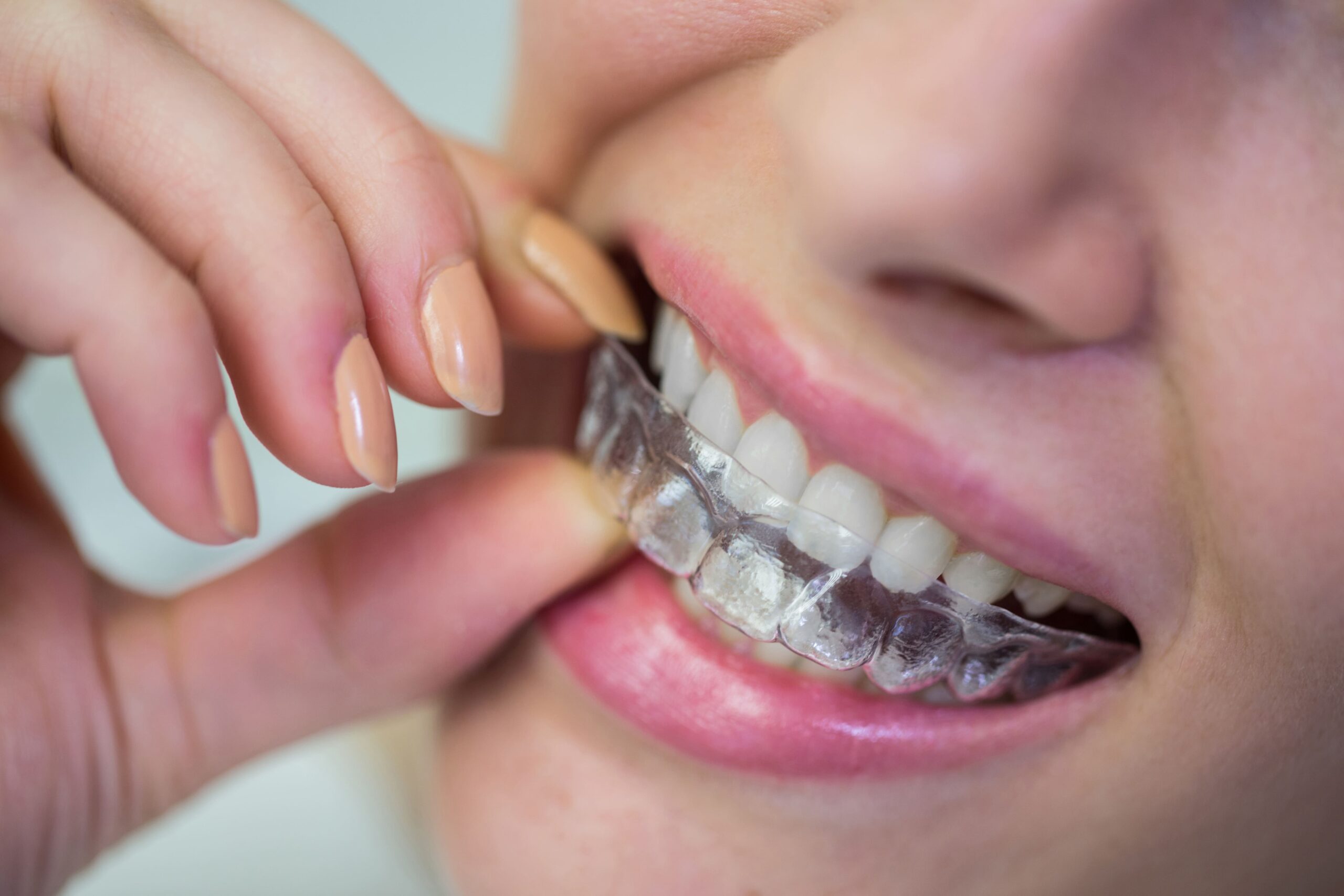 Invisalign ή Σιδεράκια; Πλεονεκτήματα και Διαφορές