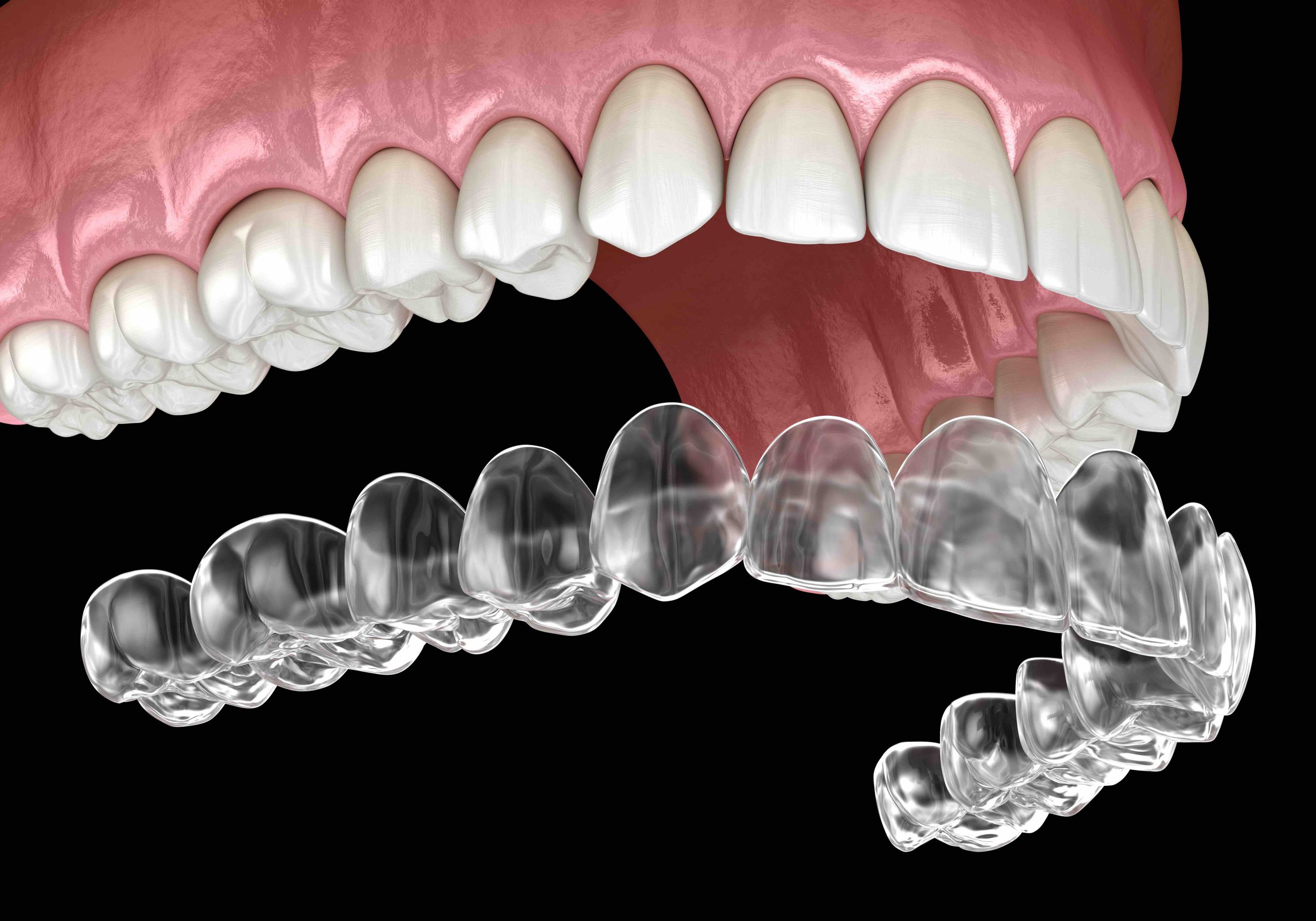 clear-braces-invisalign-scaled