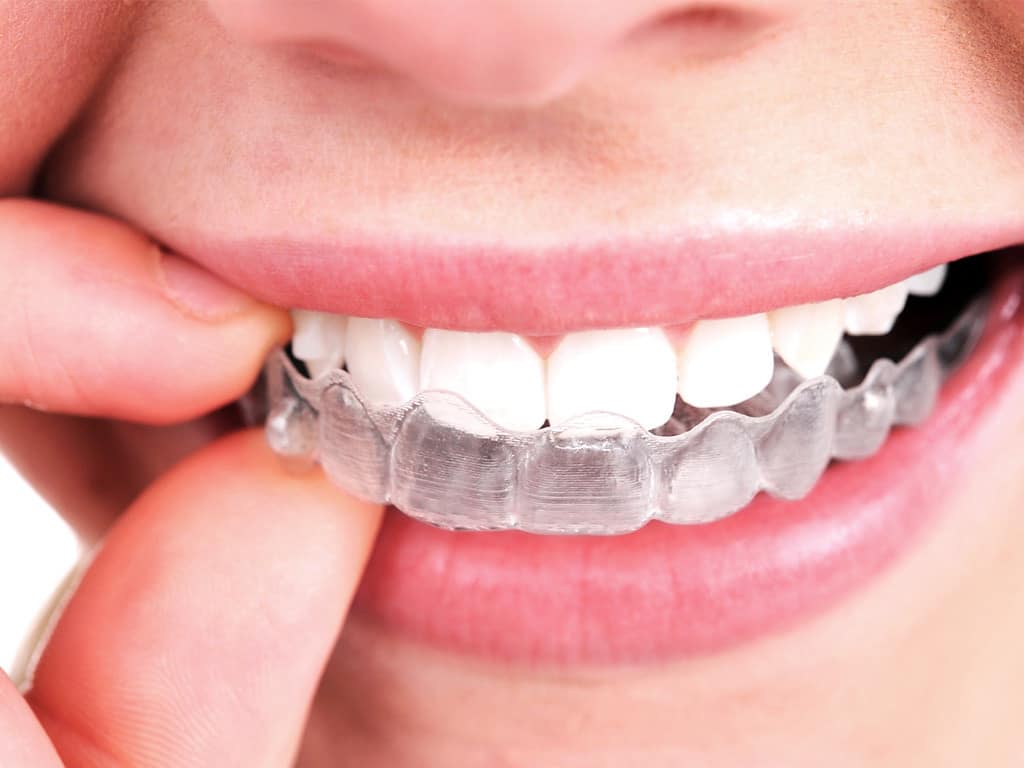 invisalign-phoenix-orthodontist