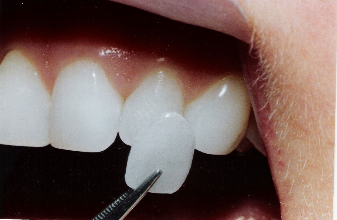 veneers-3